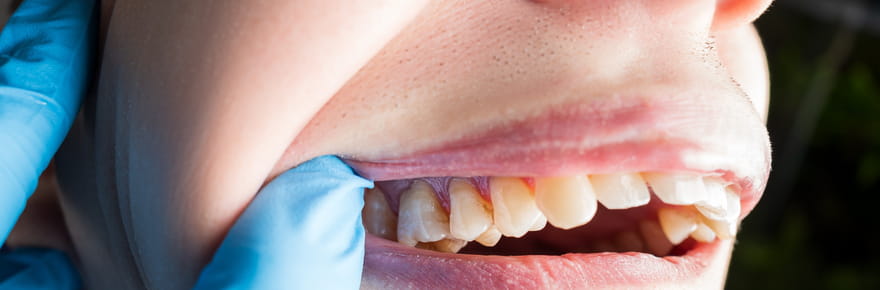 Une dentiste est formelle&nbsp;: &quot;les dents jaunes ne sont pas seulement caus&eacute;es par une mauvaise hygi&egrave;ne&quot;