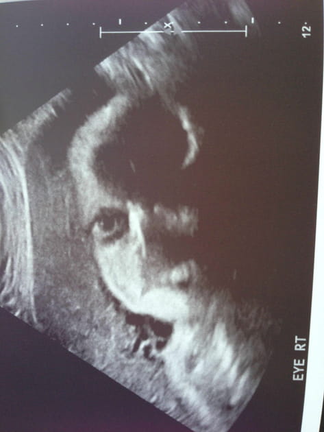 Le foetus le plus terrifiant