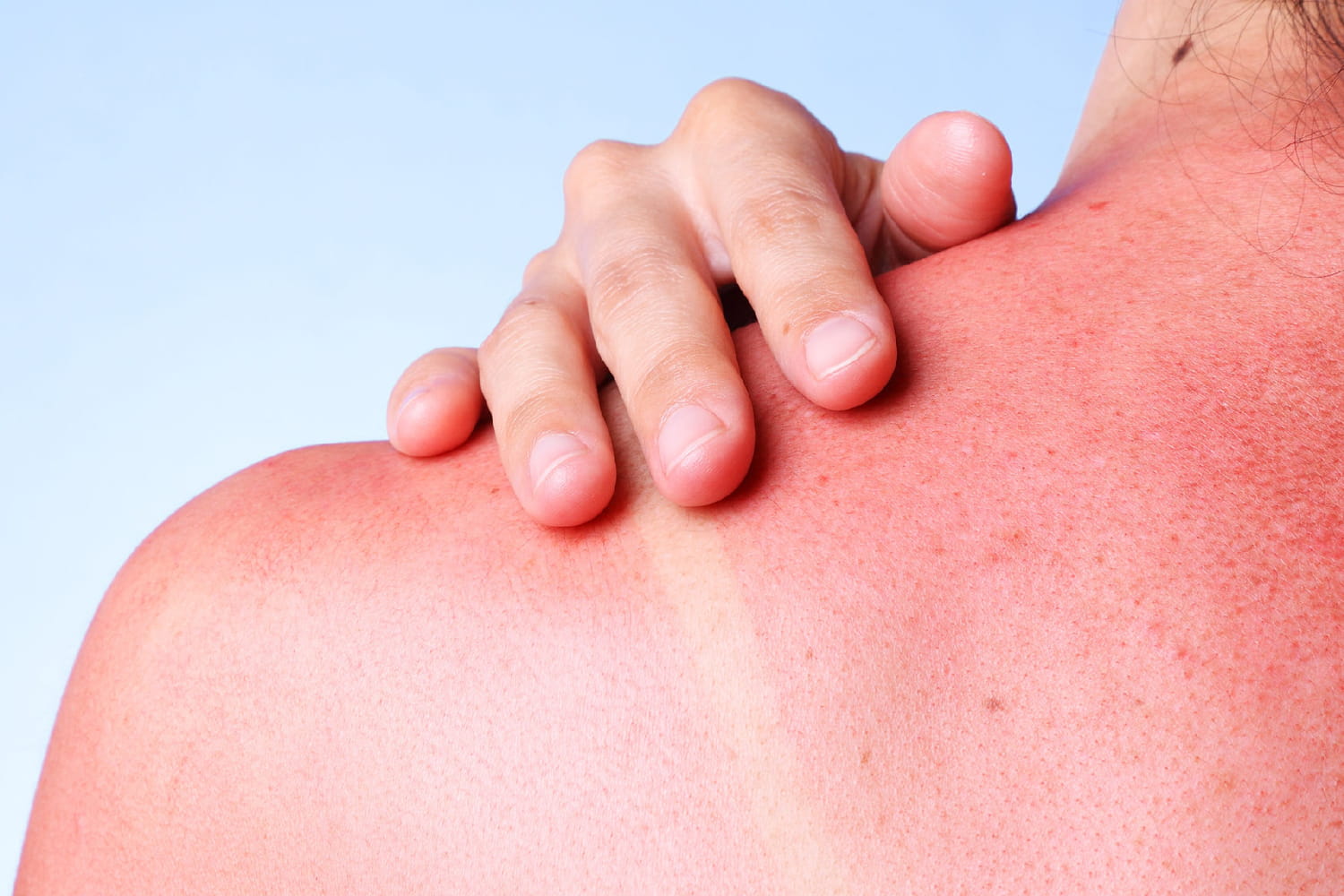 Mieux que l'eucalyptus, une seule tranche de ce fruit populaire calme les coups de soleil