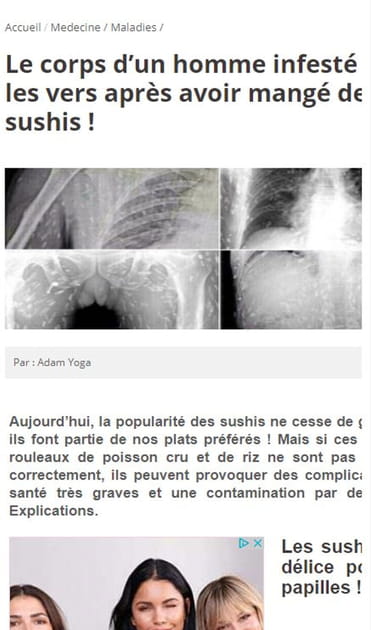 &quot;Un Chinois infest&eacute; de vers apr&egrave;s avoir mang&eacute; des sushis&quot;