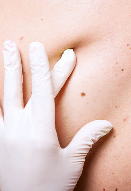 Les grains de beaut&eacute;, des cellules flemmardes