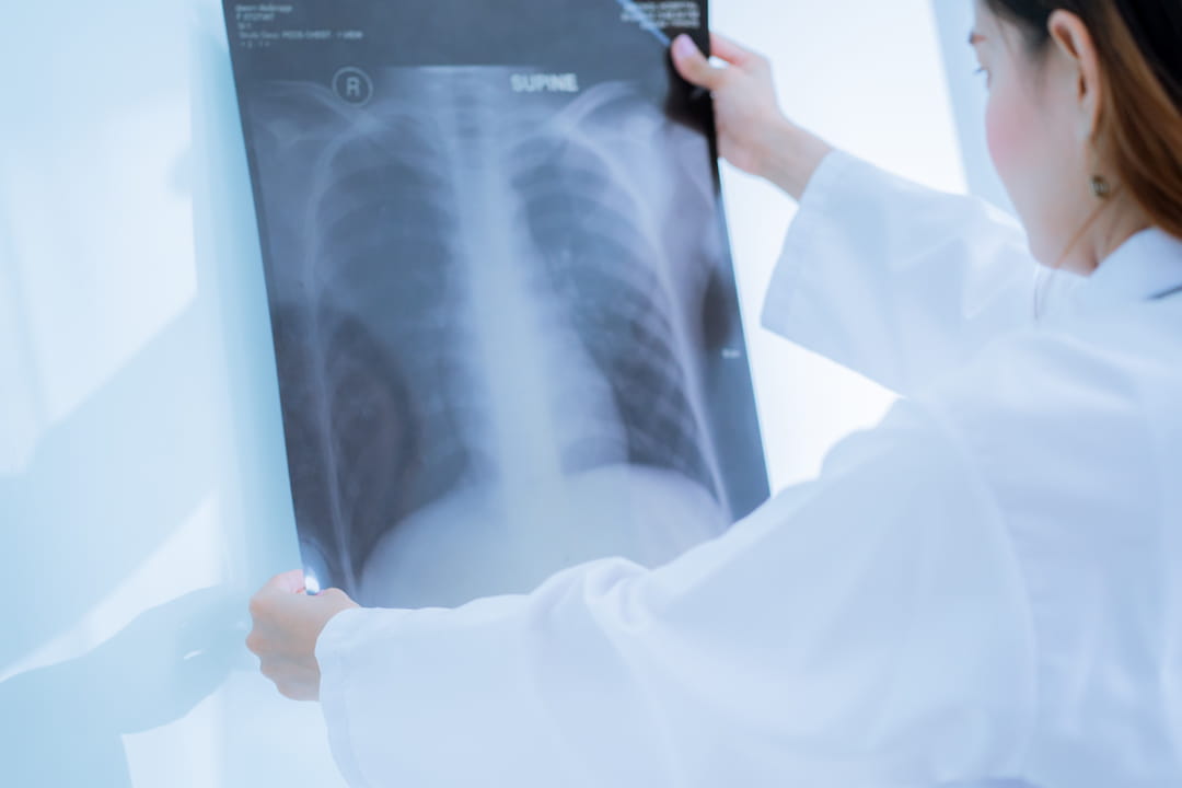 Immunothérapie en traitement du cancer du poumon