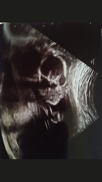 L'&eacute;chographie qui donne froid dans le dos&nbsp;!