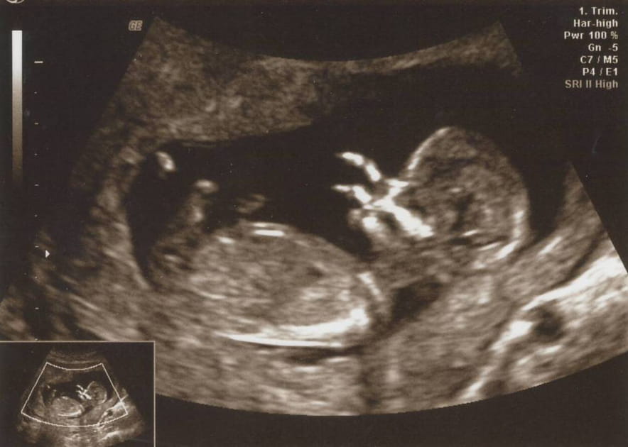 Alien versus Foetus