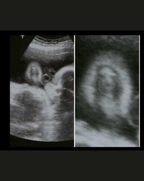 L'&eacute;chographie qui r&eacute;v&egrave;le le visage du Christ