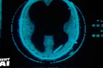 Une femme sans cerveau au zapping !