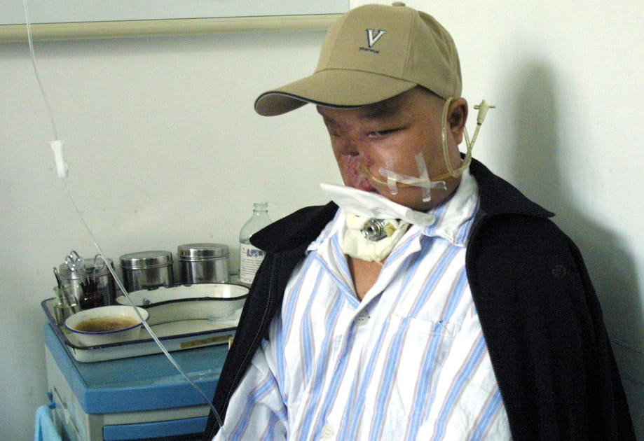Avant la transplantation