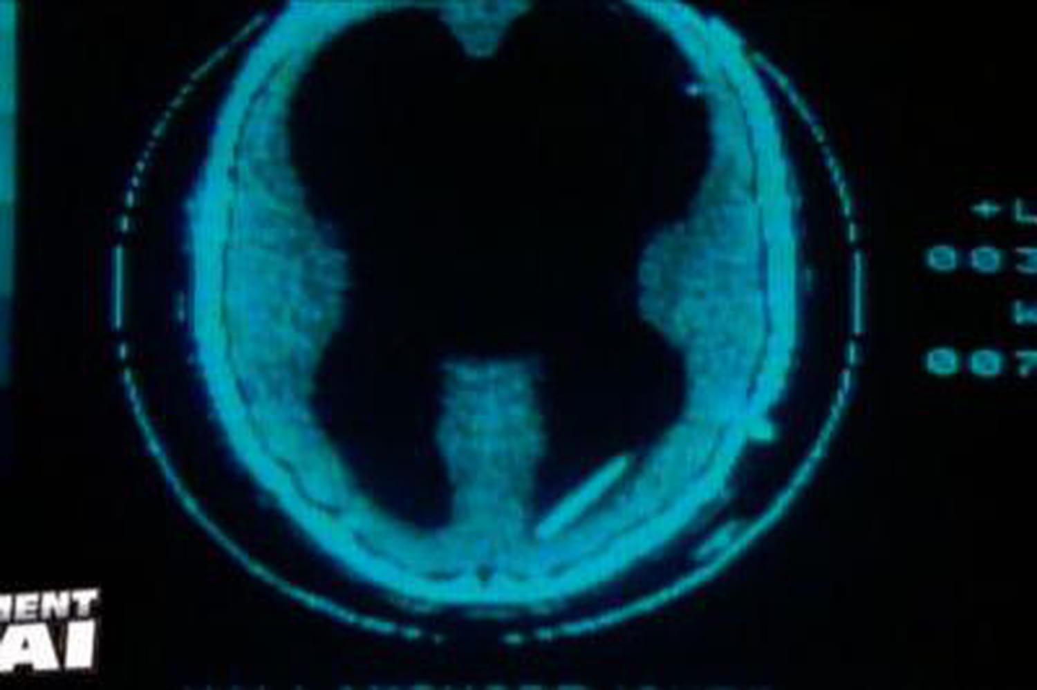 Une femme sans cerveau au zapping !