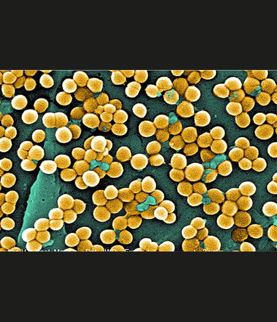 Le tr&egrave;s r&eacute;sistant staphylocoque dor&eacute;