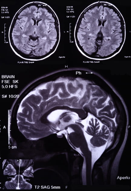 Il op&egrave;re le mauvais c&ocirc;t&eacute; du&nbsp;cerveau