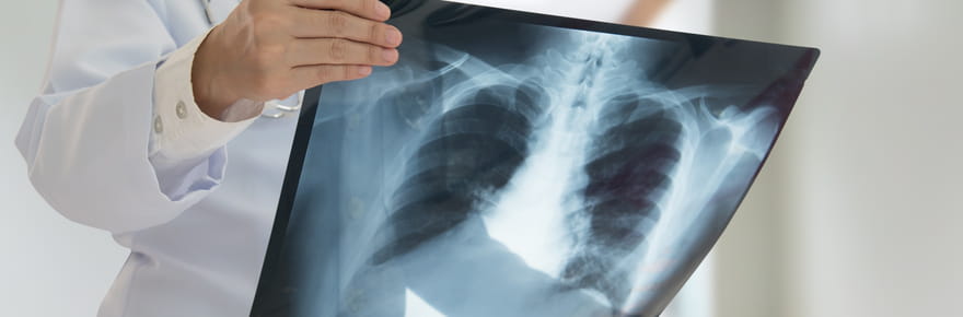 Tuberculose&nbsp;: voici les premiers sympt&ocirc;mes &agrave; surveiller