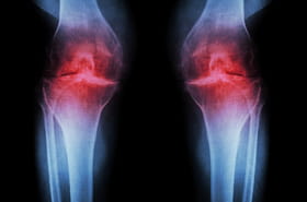 Marcher comme &ccedil;a est aussi efficace que les m&eacute;dicaments pour soulager les douleurs au genou